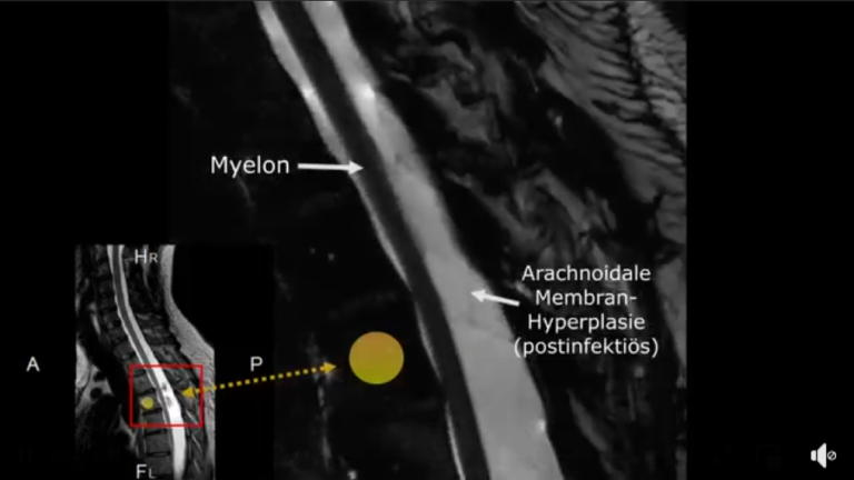 Arachnoid membrane hyperplasia