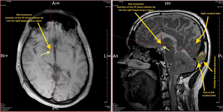 Brain malformation part 1 and more …