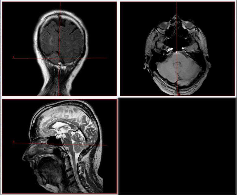 Herniation durch das Tentorium Cerebelli