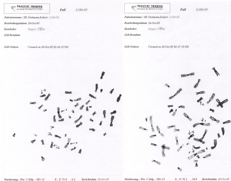 1qh + 16qh, Infertilität und ICF-Syndrom