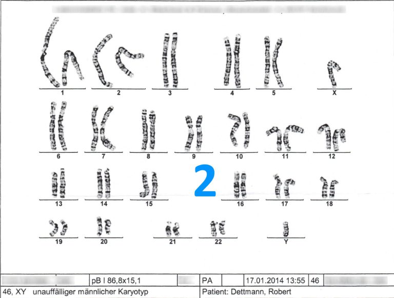 Misdiagnosis for 1qh + 16qh