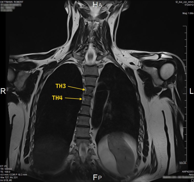 Arachnoiditis and scoliosis