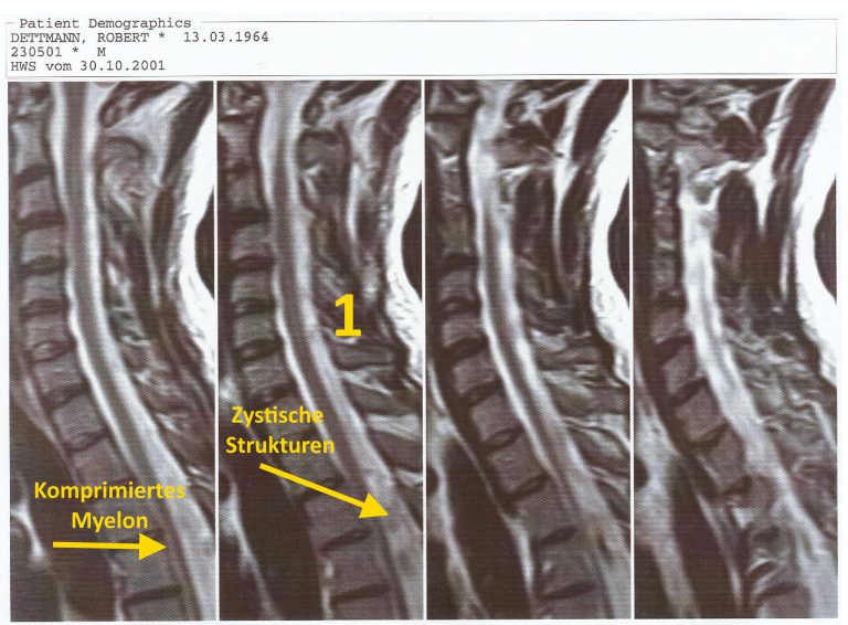 Spinale Fehldiagnostik (dutzendfach)